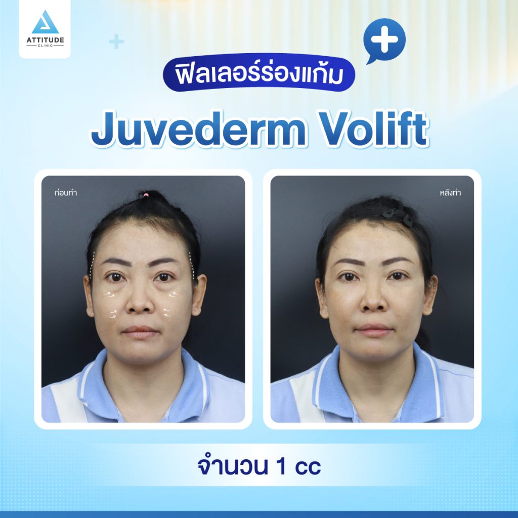 ผลลัพธ์หลังฉีดฟิลเลอร์