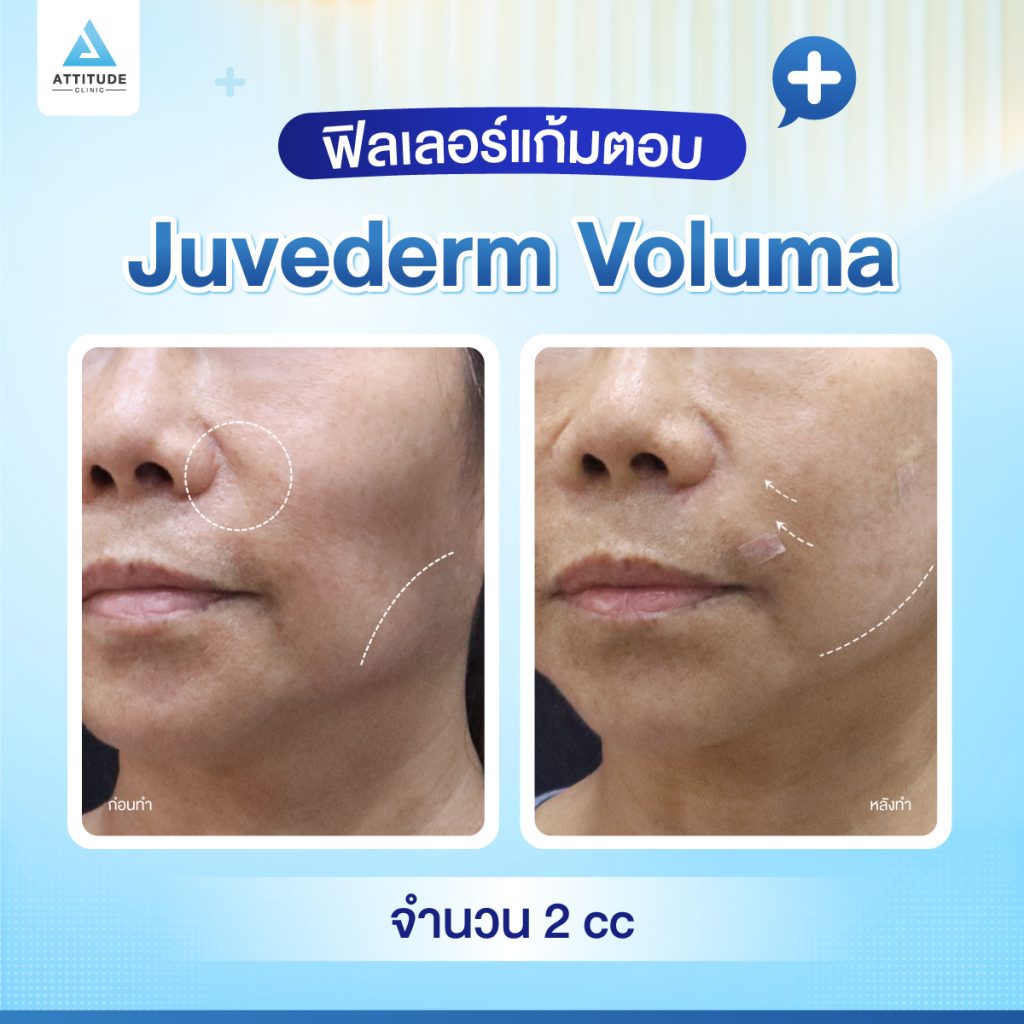 ผลลัพธ์หลังฉีดฟิลเลอร์