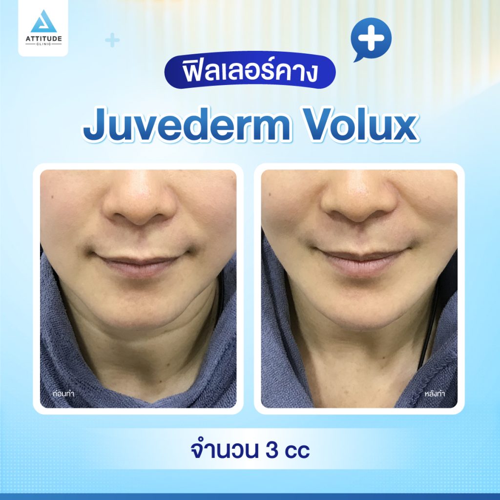 ผลลัพธ์หลังฉีดฟิลเลอร์