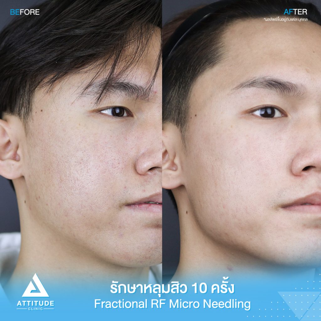 รีวิวรักษาหลุมสิว FRF Scar - Fractional Micro Needle RF จำนวน 10 ครั้ง ของคุณเรวัต หลุมสิวตื้นขึ้น ผิวหน้าแน่นฟู รูขุมขนกระชับ ผิวกลับมาเรียบเนียนมั่นใจอีกครั้งที่แอททิจูด