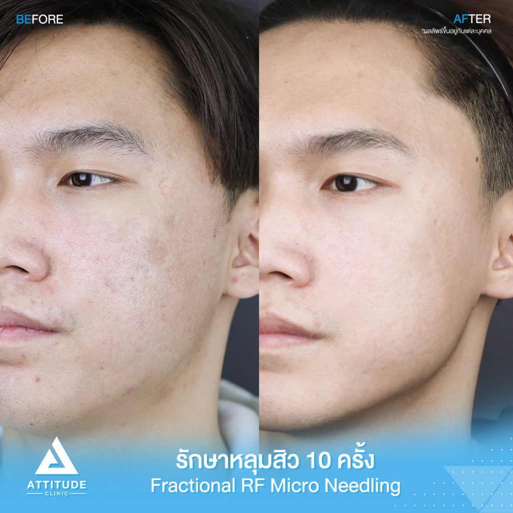 รีวิวรักษาหลุมสิว FRF Scar - Fractional Micro Needle RF จำนวน 10 ครั้ง ของคุณเรวัต หลุมสิวตื้นขึ้น ผิวหน้าแน่นฟู รูขุมขนกระชับ ผิวกลับมาเรียบเนียนมั่นใจอีกครั้งที่แอททิจูด