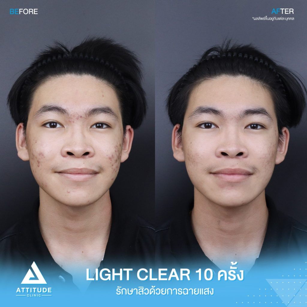 รีวิวรักษาสิว รีวิวรักษาสิว ด้วยการฉายแสงสีฟ้า โปรแกรม Light Clear 7 ขั้นตอน จำนวน 10 ครั้ง ของน้องเก็ท มีปัญหาสิว รอยสิวจัดเต็ม หลังรักษาตอนนี้หน้าใสมั่นใจขึ้นสุดๆ