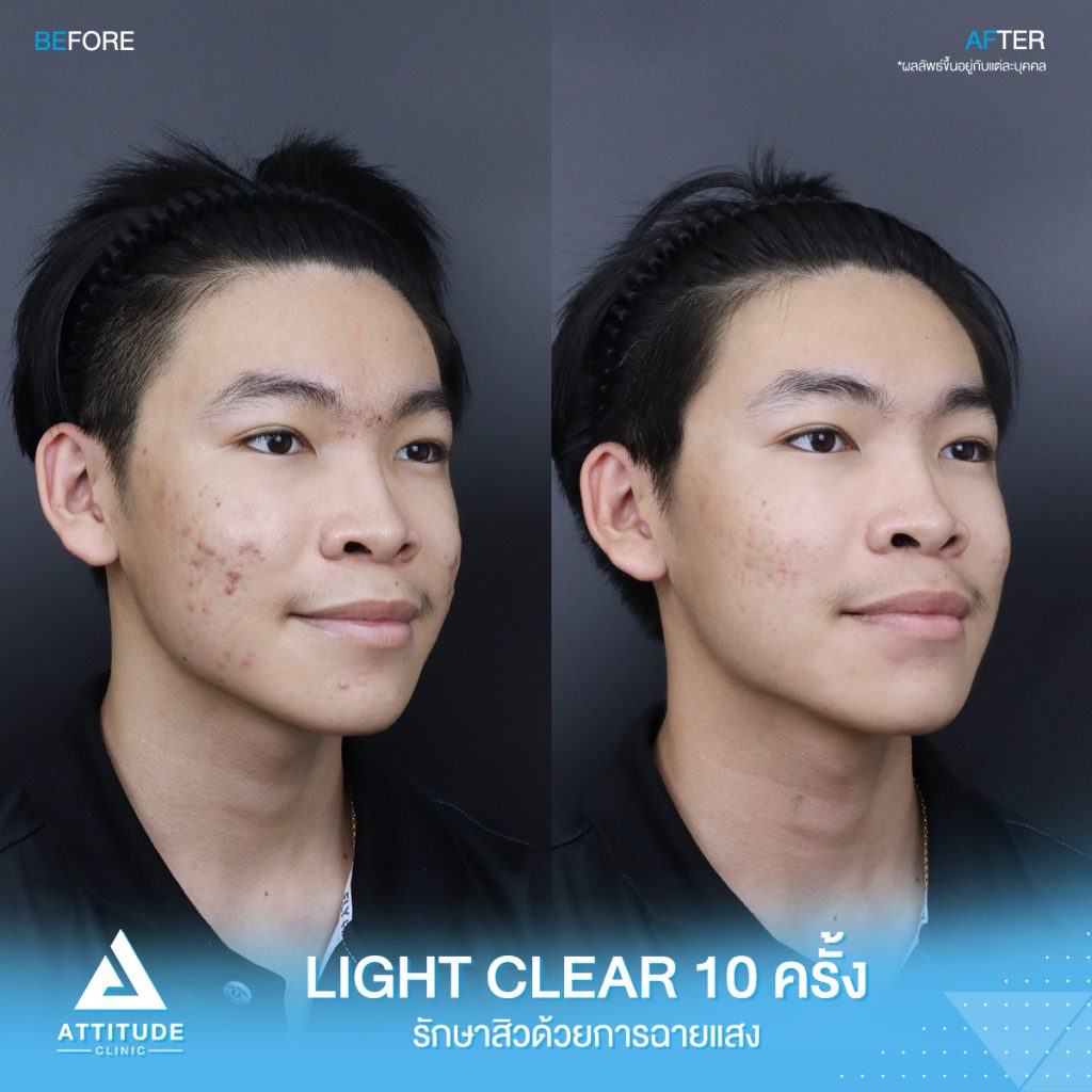 รีวิวรักษาสิว ด้วยการฉายแสงสีฟ้า โปรแกรม Light Clear 7 ขั้นตอน จำนวน 10 ครั้ง ของน้องเก็ท มีปัญหาสิว รอยสิวจัดเต็ม หลังรักษาตอนนี้หน้าใสมั่นใจขึ้นสุดๆ