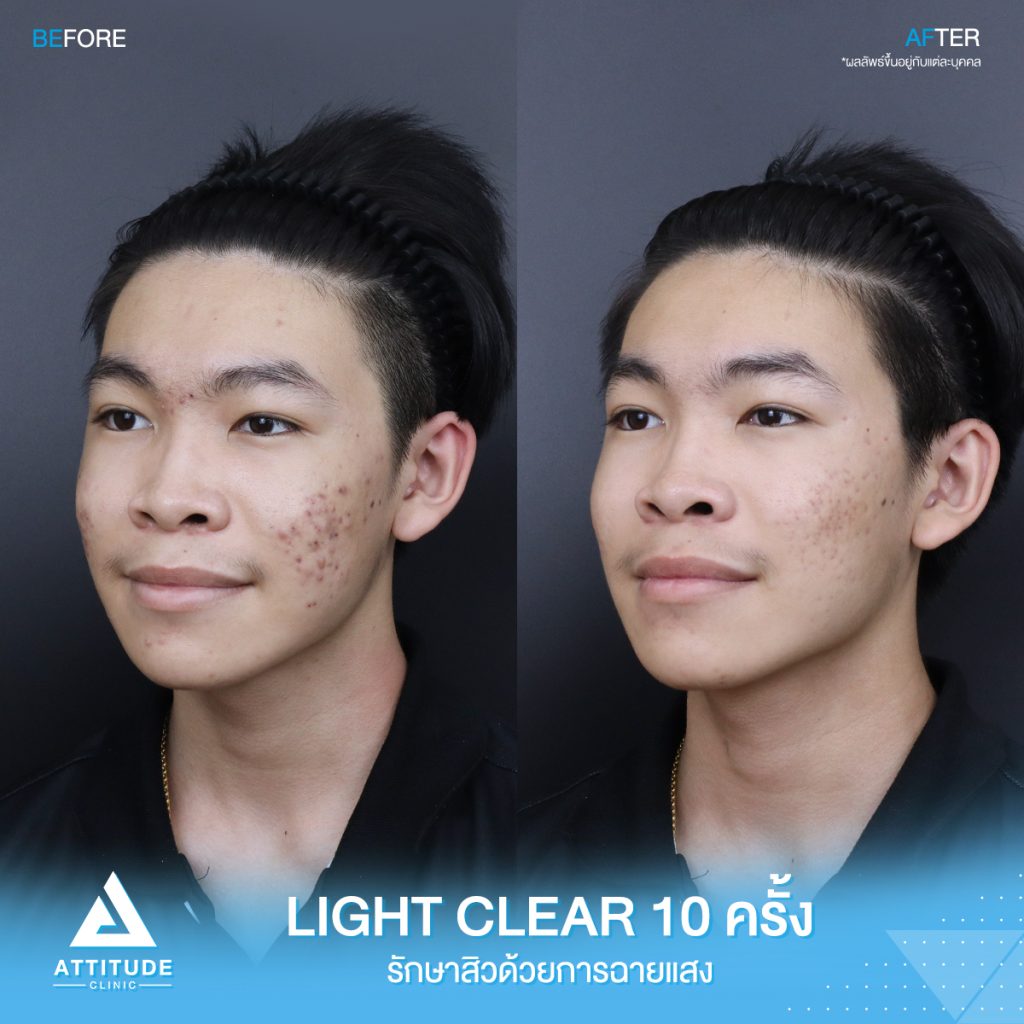 รีวิวรักษาสิว ด้วยการฉายแสงสีฟ้า โปรแกรม Light Clear 7 ขั้นตอน จำนวน 10 ครั้ง ของน้องเก็ท มีปัญหาสิว รอยสิวจัดเต็ม หลังรักษาตอนนี้หน้าใสมั่นใจขึ้นสุดๆ