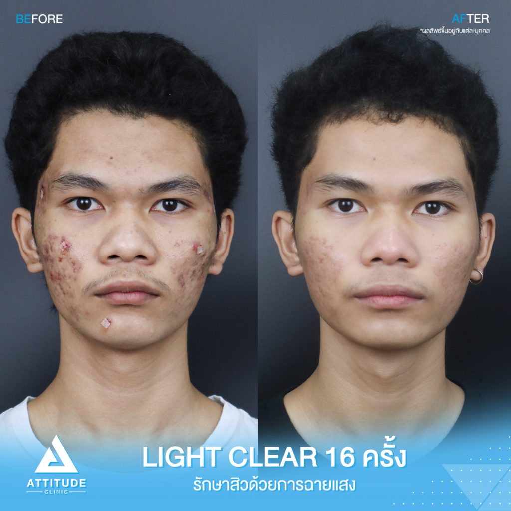 รีวิวรักษาสิว ด้วยการฉายแสง โปรแกรม Light Clear 7 ขั้นตอน จำนวน 16 ครั้ง ของน้องแทน มีปัญหาสิว รอยสิว และหลุมสิว หลังรักษาครบคอร์สหน้าใสขึ้นมาก เพิ่มความมั่นใจขึ้นสุดๆ