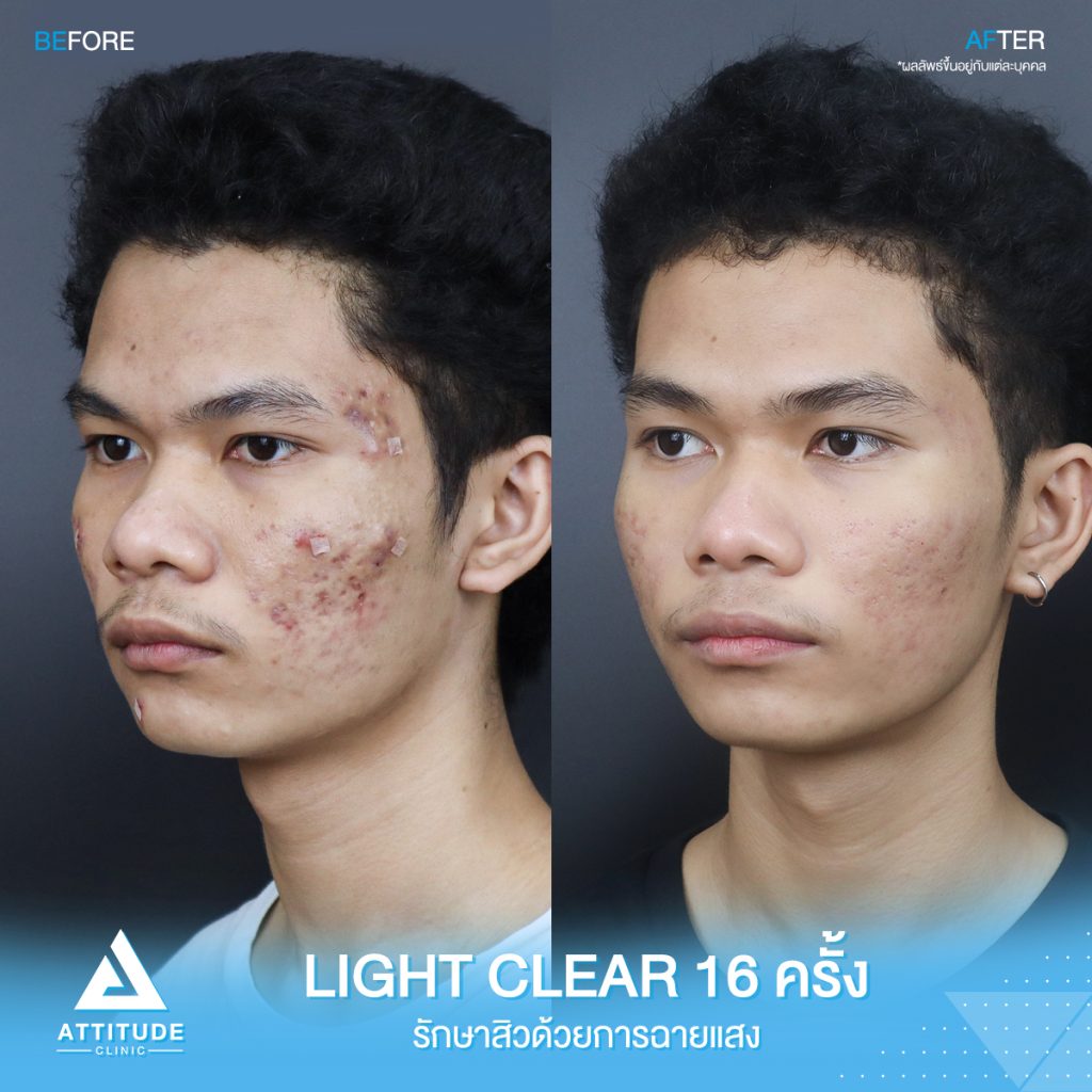 รีวิวรักษาสิว ด้วยการฉายแสง โปรแกรม Light Clear 7 ขั้นตอน จำนวน 16 ครั้ง ของน้องแทน มีปัญหาสิว รอยสิว และหลุมสิว หลังรักษาครบคอร์สหน้าใสขึ้นมาก เพิ่มความมั่นใจขึ้นสุดๆ