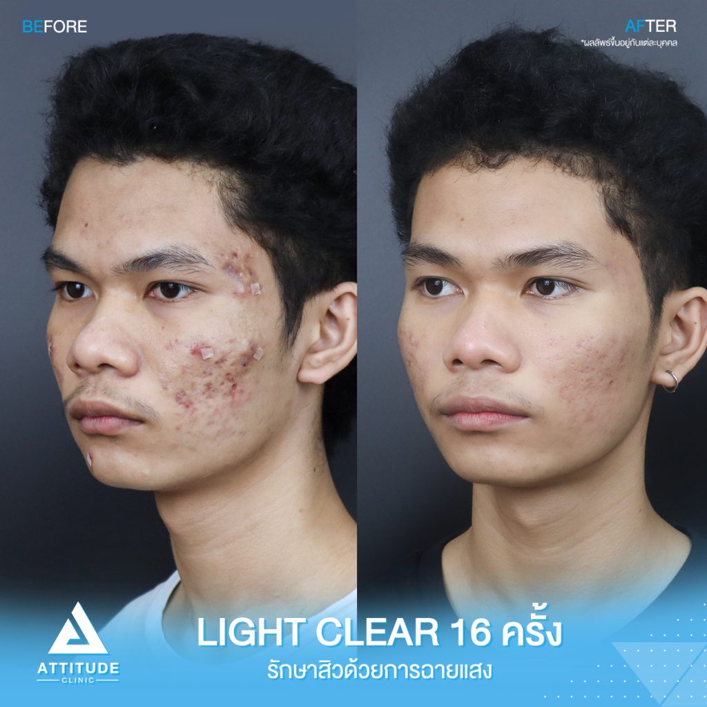 รีวิวรักษาสิว รีวิวรักษาสิว ด้วยการฉายแสง โปรแกรม Light Clear 7 ขั้นตอน จำนวน 16 ครั้ง ของน้องแทน มีปัญหาสิว รอยสิว และหลุมสิว หลังรักษาครบคอร์สหน้าใสขึ้นมาก เพิ่มความมั่นใจขึ้นสุดๆ