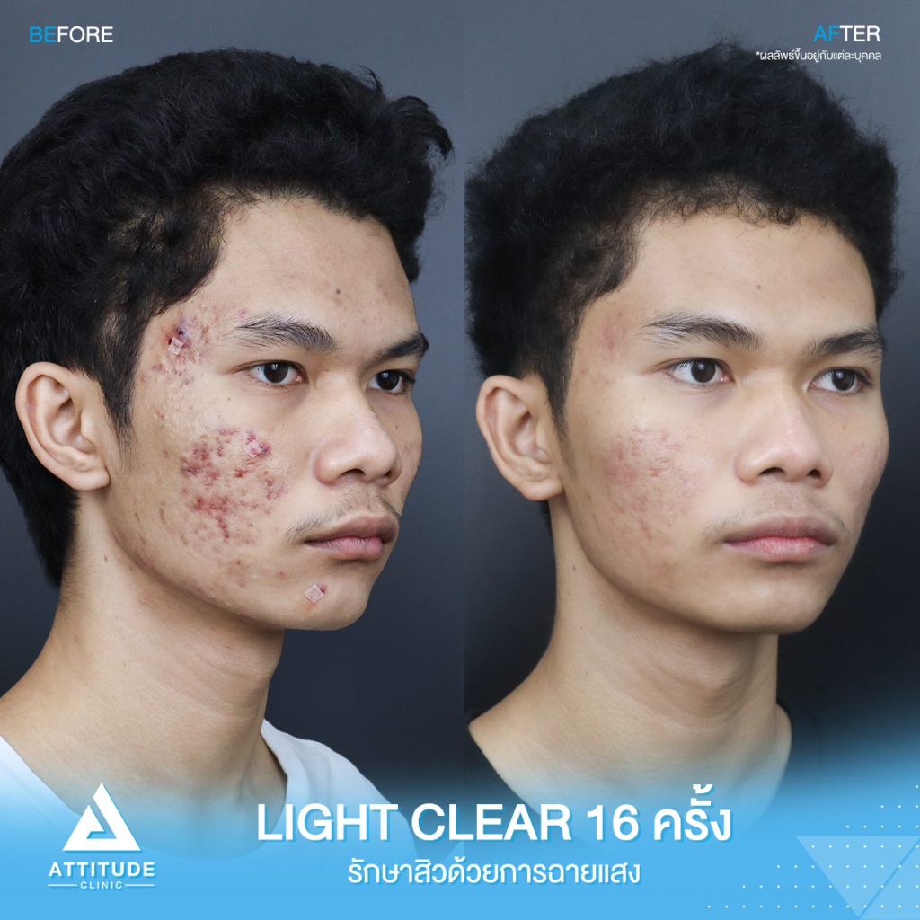 รีวิวรักษาสิว ด้วยการฉายแสง โปรแกรม Light Clear 7 ขั้นตอน จำนวน 16 ครั้ง ของน้องแทน มีปัญหาสิว รอยสิว และหลุมสิว หลังรักษาครบคอร์สหน้าใสขึ้นมาก เพิ่มความมั่นใจขึ้นสุดๆ