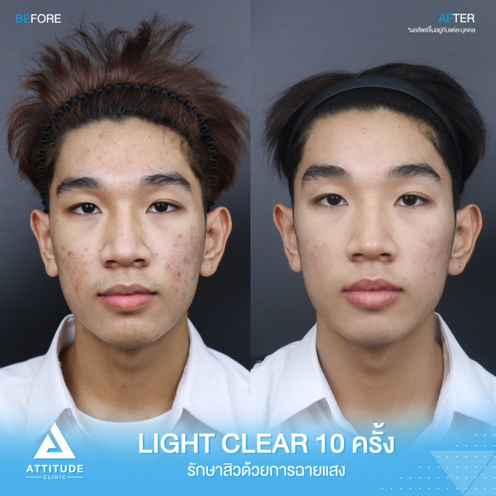 รีวิวรักษาสิว ด้วยการฉายแสงสีฟ้า โปรแกรม Light Clear 7 ขั้นตอน จำนวน 10 ครั้ง ของน้องช้าง มีปัญหาสิว รอยสิวจัดเต็ม หลังรักษาตอนนี้หน้าใสมั่นใจขึ้นสุดๆ