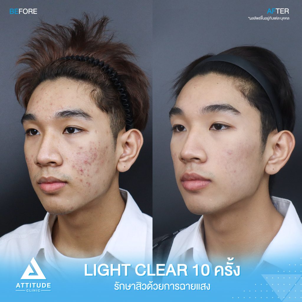 รีวิวรักษาสิว ด้วยการฉายแสงสีฟ้า โปรแกรม Light Clear 7 ขั้นตอน จำนวน 10 ครั้ง ของน้องช้าง มีปัญหาสิว รอยสิวจัดเต็ม หลังรักษาตอนนี้หน้าใสมั่นใจขึ้นสุดๆ