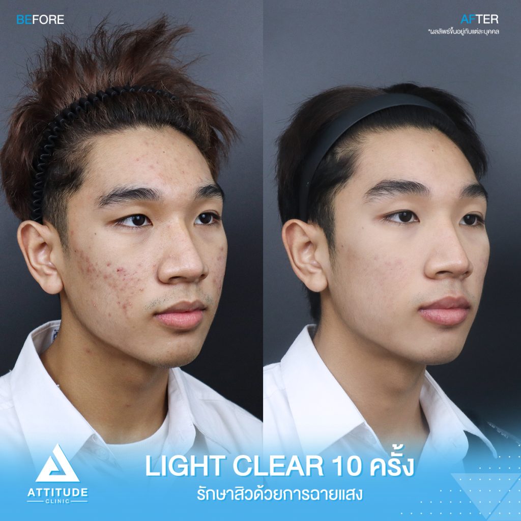 รีวิวรักษาสิว ด้วยการฉายแสงสีฟ้า โปรแกรม Light Clear 7 ขั้นตอน จำนวน 10 ครั้ง ของน้องช้าง มีปัญหาสิว รอยสิวจัดเต็ม หลังรักษาตอนนี้หน้าใสมั่นใจขึ้นสุดๆ