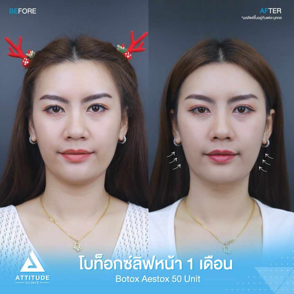 เทคนิคฉีดโบท็อกซ์ลิ๊ฟหน้า ยกกระชับ ปรับหน้าเรียวด้วย Dermo Lift และ Nefertiti Lift คืออะไร? เหมือนกันมั้ย? ต้องฉีดแบบไหน?