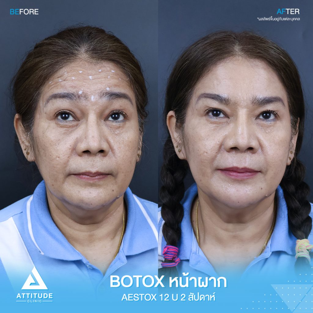 รีวิวฉีดโบท็อกซ์ ลดริ้วรอยทั่วหน้า upper face จำนวน 50 Unit หน้าดูเด็กลง มั่นใจมากขึ้น ดูแลโดยแพทย์ผู้ชำนาญการ