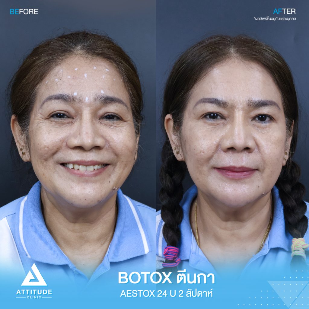 รีวิวฉีดโบท็อกซ์ ลดริ้วรอยทั่วหน้า upper face จำนวน 50 Unit หน้าดูเด็กลง มั่นใจมากขึ้น ดูแลโดยแพทย์ผู้ชำนาญการ