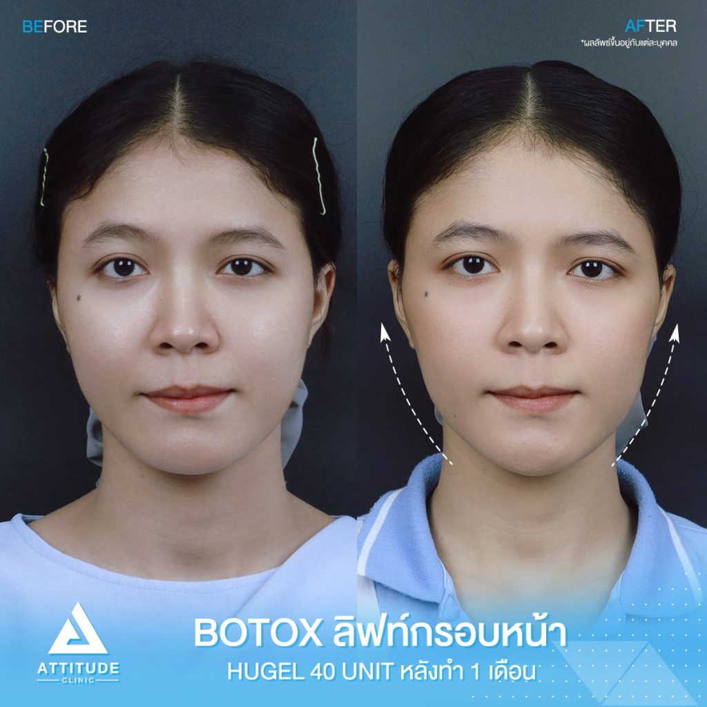 เทคนิคฉีดโบท็อกซ์ลิ๊ฟหน้า ยกกระชับ ปรับหน้าเรียวด้วย Dermo Lift และ Nefertiti Lift คืออะไร?​ เหมือนกันมั้ย? ต้องฉีดแบบไหน?