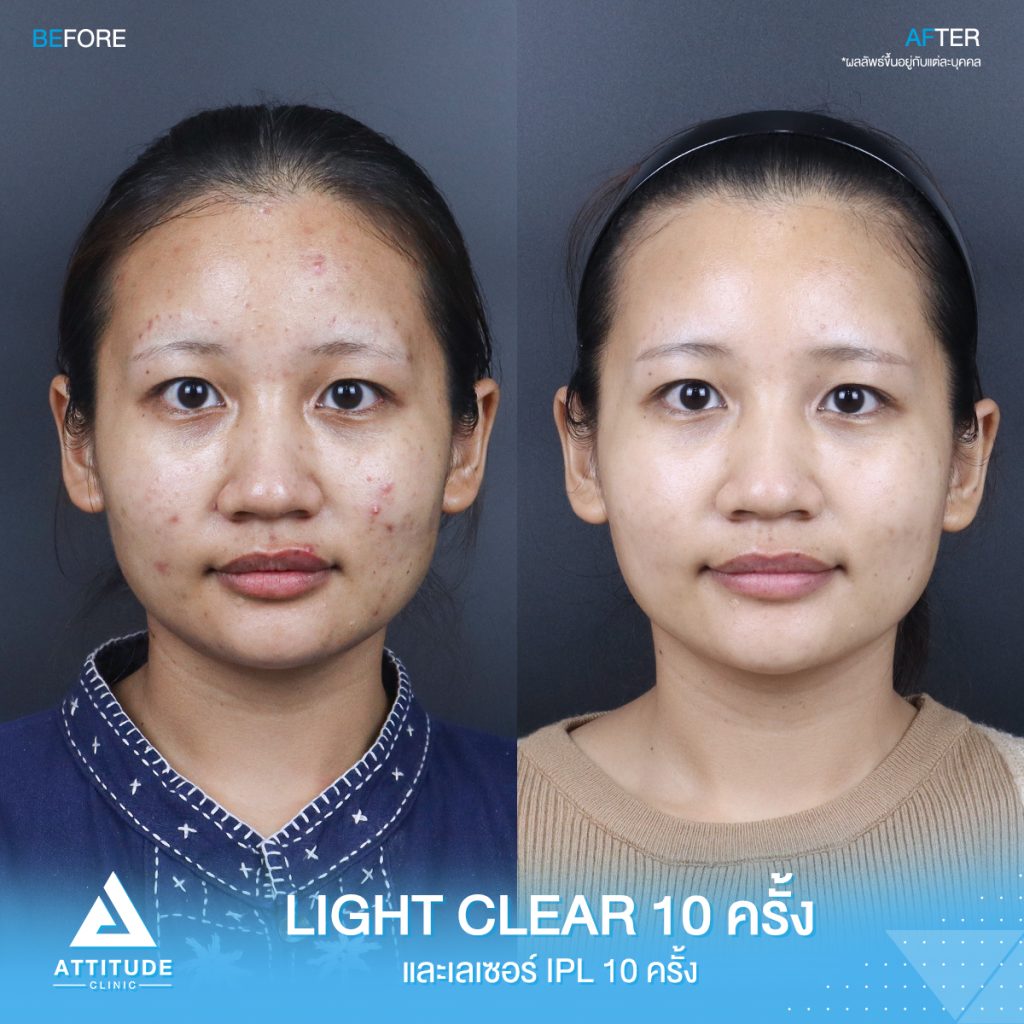 รีวิวรักษาสิวครบวงจร โปรแกรม Light Clear 7 ขั้นตอน จำนวน 10 ครั้ง เลเซอร์หน้าใส Cellec V IPL จำนวน 10 ครั้ง ของคุณภัทรวดี ตอนนี้ผมใสวิ้ง มั่นใจขึ้นสุดๆ 