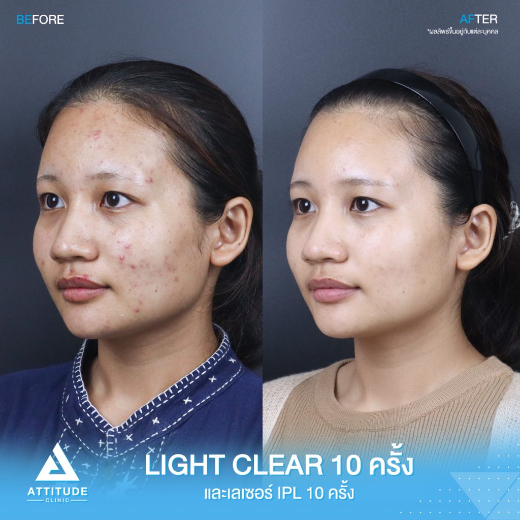 รีวิวรักษาสิวครบวงจร โปรแกรม Light Clear 7 ขั้นตอน จำนวน 10 ครั้ง เลเซอร์หน้าใส Cellec V IPL จำนวน 10 ครั้ง ของคุณภัทรวดี ตอนนี้ผมใสวิ้ง มั่นใจขึ้นสุดๆ