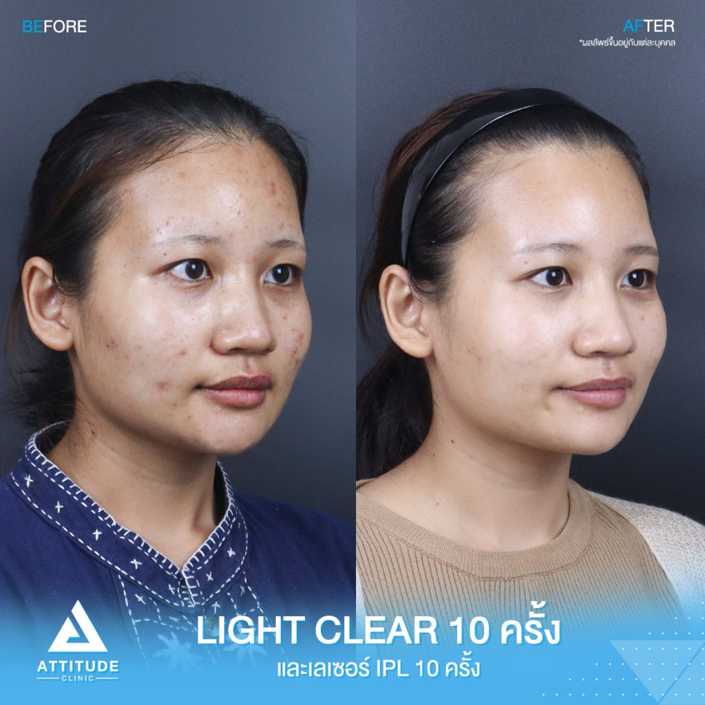 รีวิวรักษาสิวครบวงจร โปรแกรม Light Clear 7 ขั้นตอน จำนวน 10 ครั้ง เลเซอร์หน้าใส Cellec V IPL จำนวน 10 ครั้ง ของคุณภัทรวดี ตอนนี้ผมใสวิ้ง มั่นใจขึ้นสุดๆ