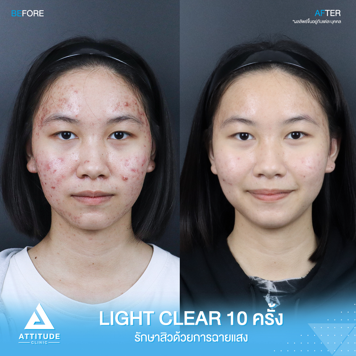 รีวิวรักษาสิว ด้วยการฉายแสงสีฟ้า โปรแกรม Light Clear 7 ขั้นตอน จำนวน 10 ครั้ง ของน้องนิว มีปัญหาสิว รอยสิวจัดเต็ม หลังรักษาตอนนี้หน้าใสมั่นใจขึ้นสุดๆ