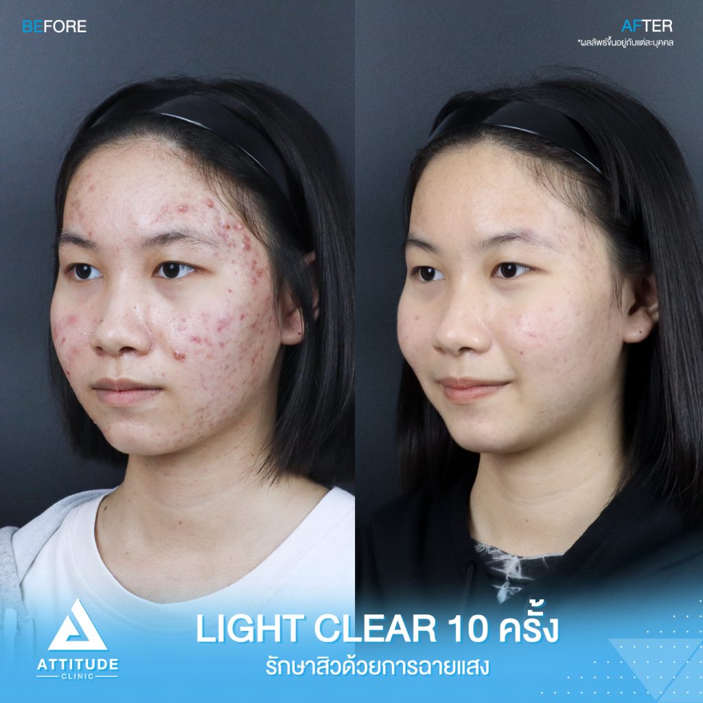 รีวิวรักษาสิว ด้วยการฉายแสงสีฟ้า โปรแกรม Light Clear 7 ขั้นตอน จำนวน 10 ครั้ง ของน้องนิว มีปัญหาสิว รอยสิวจัดเต็ม หลังรักษาตอนนี้หน้าใสมั่นใจขึ้นสุดๆ