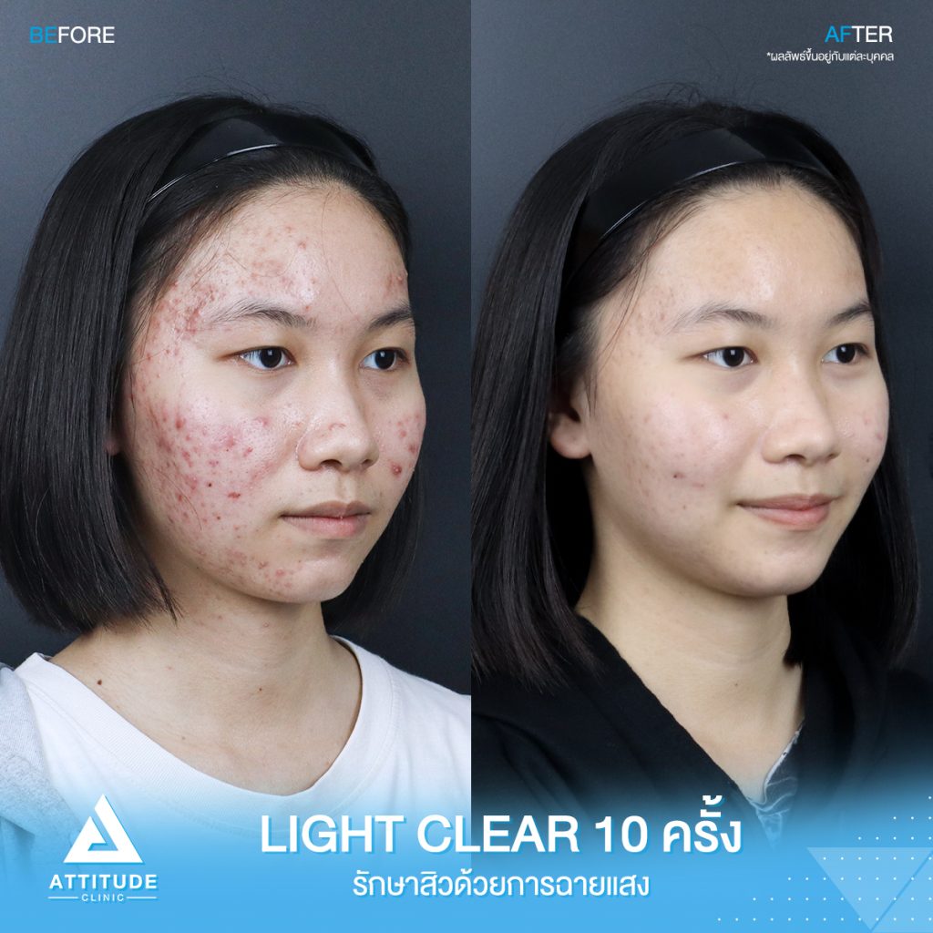 รีวิวรักษาสิว ด้วยการฉายแสงสีฟ้า โปรแกรม Light Clear 7 ขั้นตอน จำนวน 10 ครั้ง ของน้องนิว มีปัญหาสิว รอยสิวจัดเต็ม หลังรักษาตอนนี้หน้าใสมั่นใจขึ้นสุดๆ