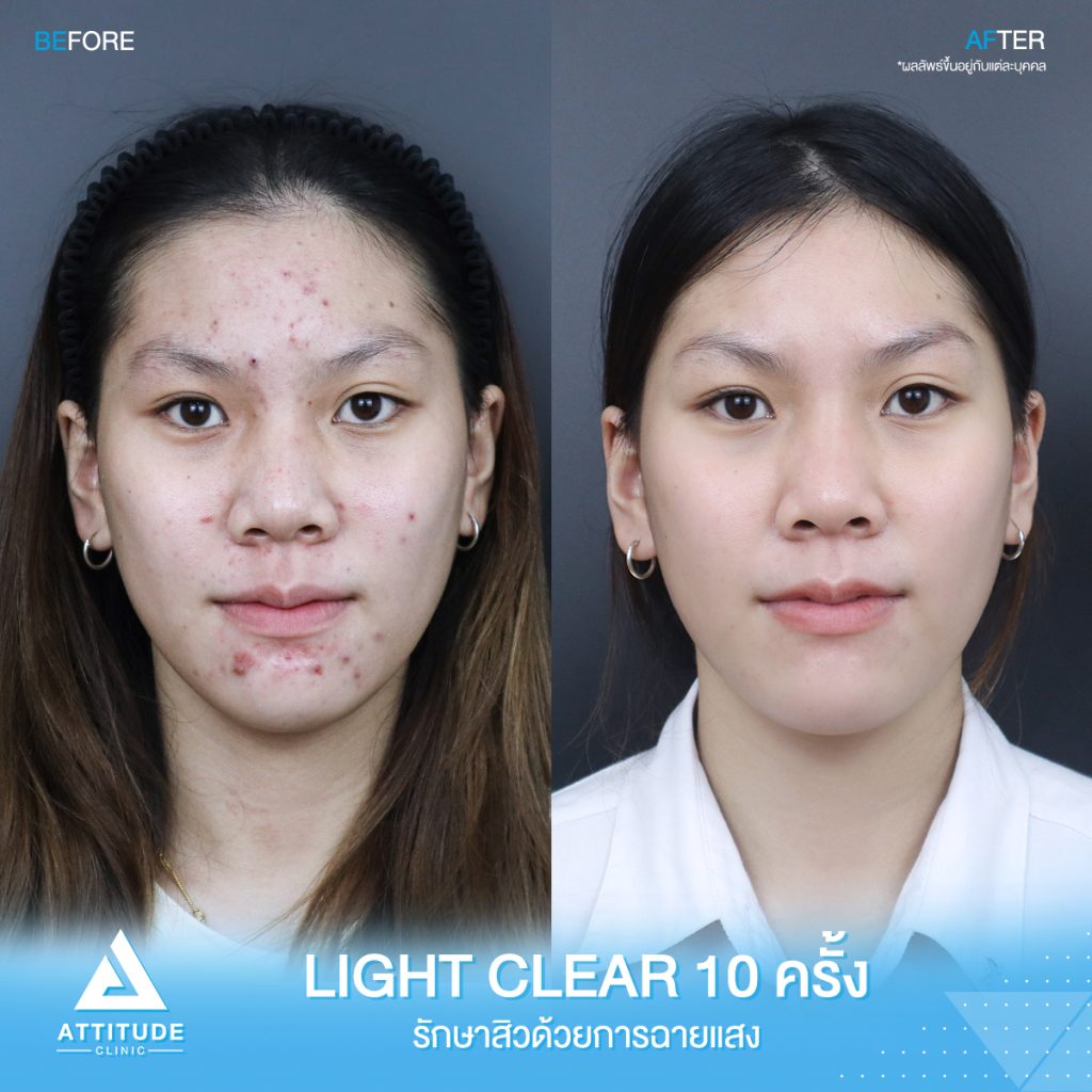 รักษาสิวที่แอททิจูดได้ ยากิน ยาทา แถมฟรี! รวมอยู่ในคอร์สเลย ไม่ต้องจ่ายเพิ่ม! คุ้มสุดๆ มาดูกันว่ามียาตัวไหนบ้าง และขั้นตอนการกินยา ทายา ทำตามนี้สิวหายชัวร์!
