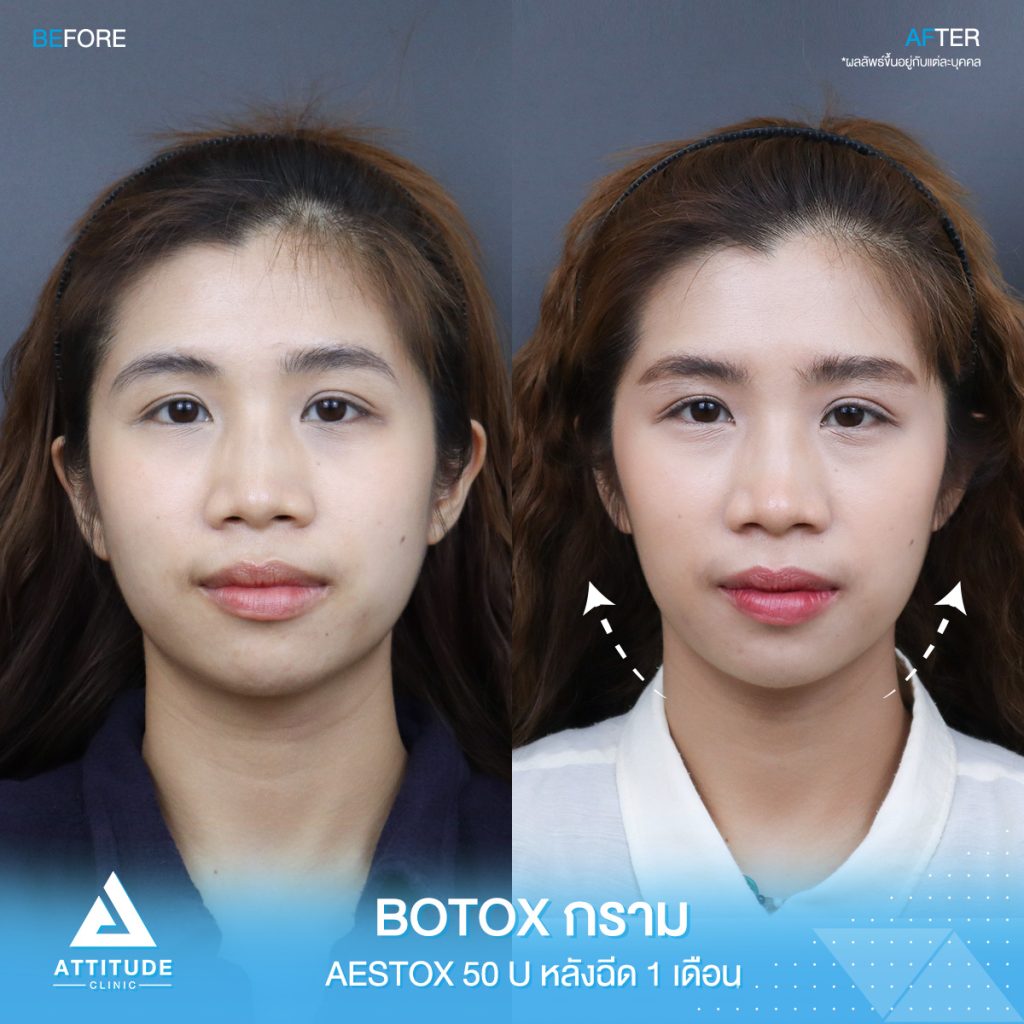 รีวิวฉีดโบท็อกซ์กราม Aestox จำนวน 50 unit ของคุณพลอย ปรับรูปหน้าให้ดูเรียว เรียวสวยวีเชฟ เพิ่มความมั่นใจ ที่แอททิจูดคลินิก