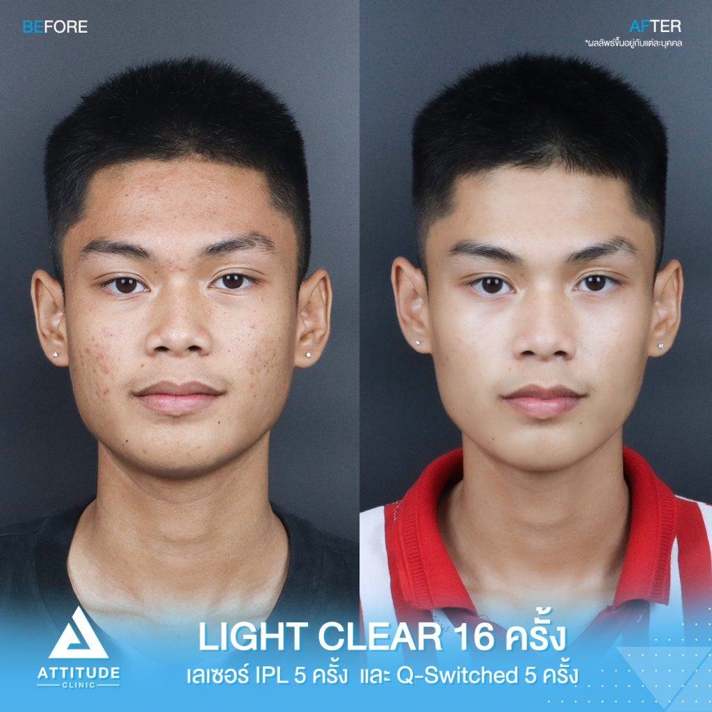 รักษาสิวที่แอททิจูดได้ ยากิน ยาทา แถมฟรี! รวมอยู่ในคอร์สเลย ไม่ต้องจ่ายเพิ่ม! คุ้มสุดๆ มาดูกันว่ามียาตัวไหนบ้าง และขั้นตอนการกินยา ทายา ทำตามนี้สิวหายชัวร์!