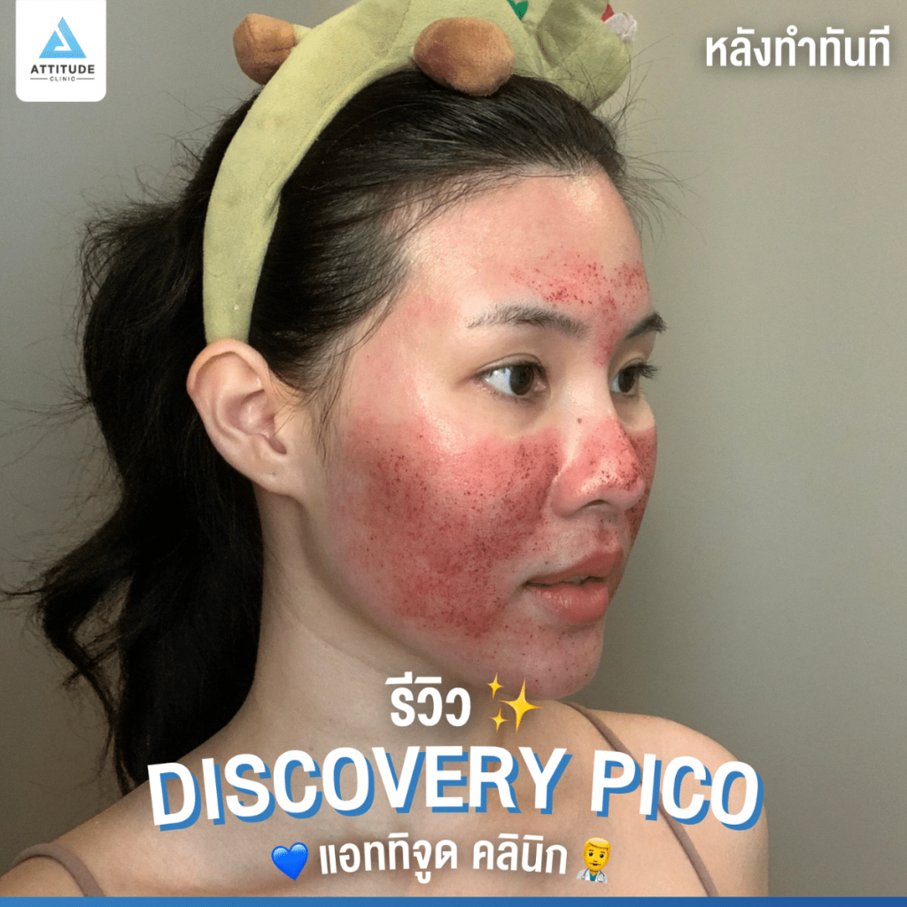 เทียบผลใน 7 วัน โปรโมชั่น 1 แถม 1 Discovery Pico เลเซอร์ดีที่สุดในการจัดการปัญหาผิวหน้า เพียงครั้งละ 12,000.- ยิงจุกไม่จำกัดช็อตทั่วหน้า 