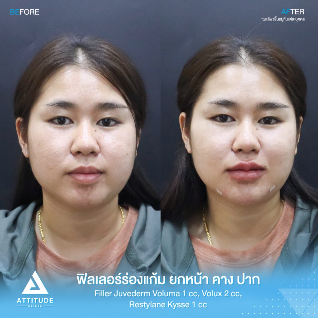 รีวิวฉีดฟิลเลอร์คุณเวียงทอง เติมร่องแก้ม ยกหน้า Juvederm Voluma 1cc เติมปาก Restylane kysse 1 cc เติมคาง Juvederm volux 2 cc รวม 4 cc เติมเต็ม ปรับรูปหน้าให้สวยสดใสย้อนวัย