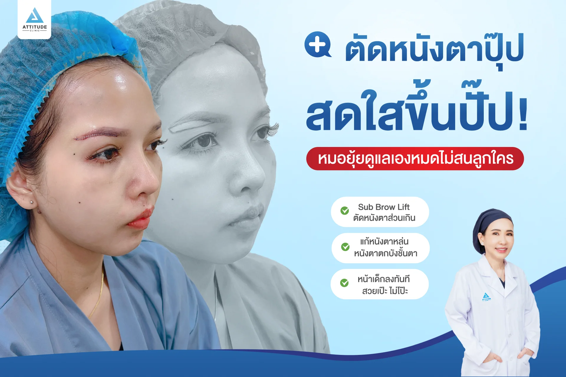 Sub Brow Lift
