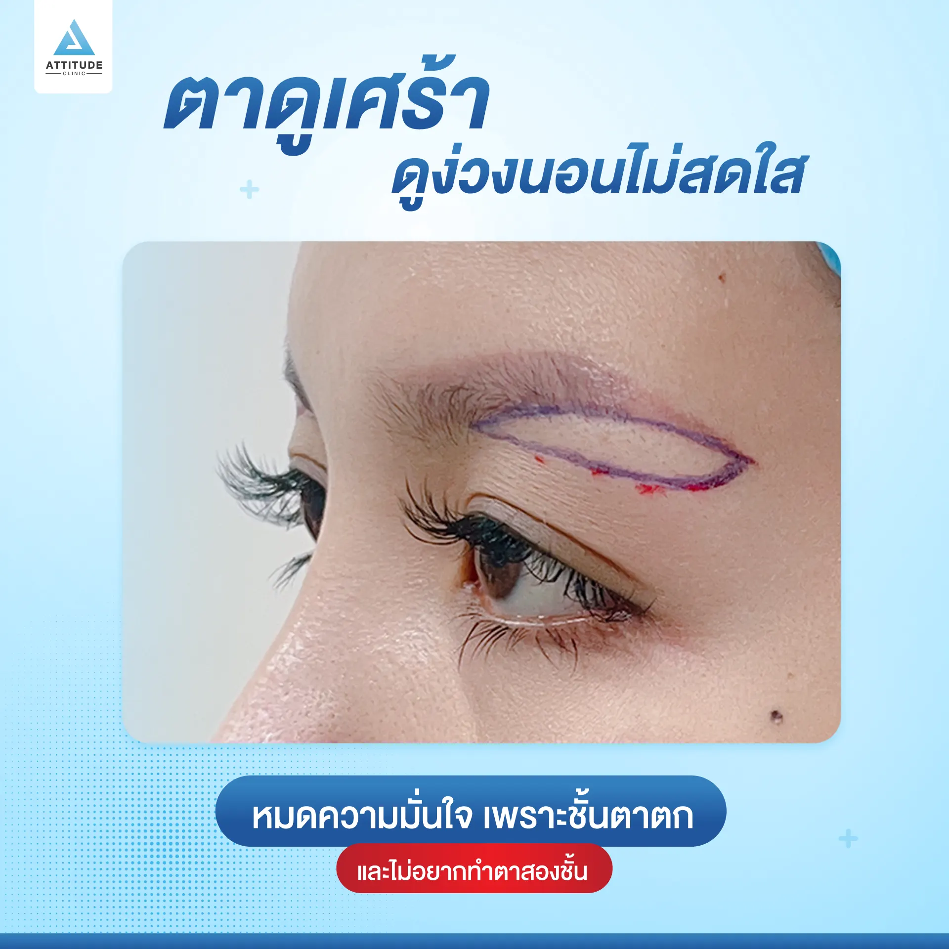 Sub Brow Lift