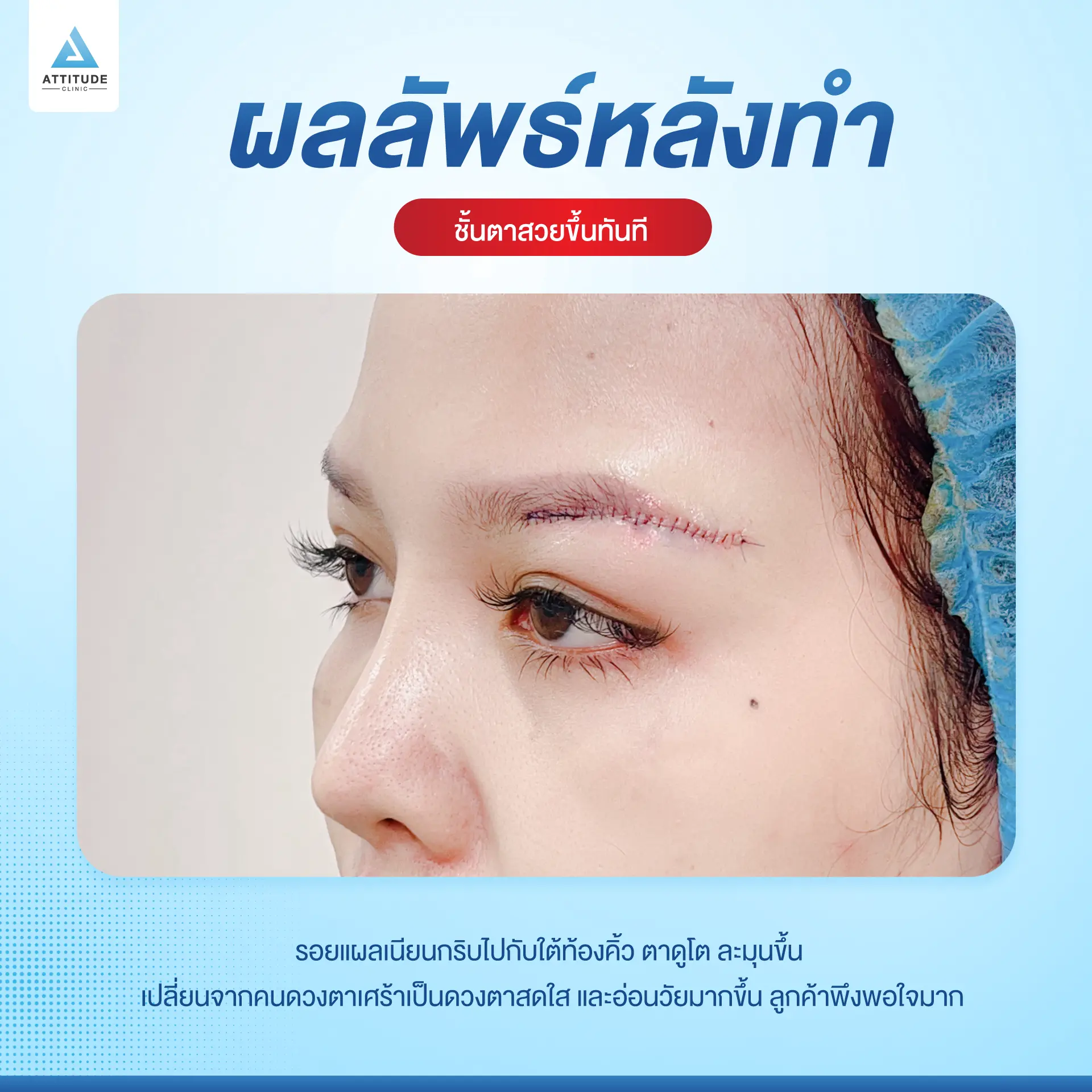 Sub Brow Lift