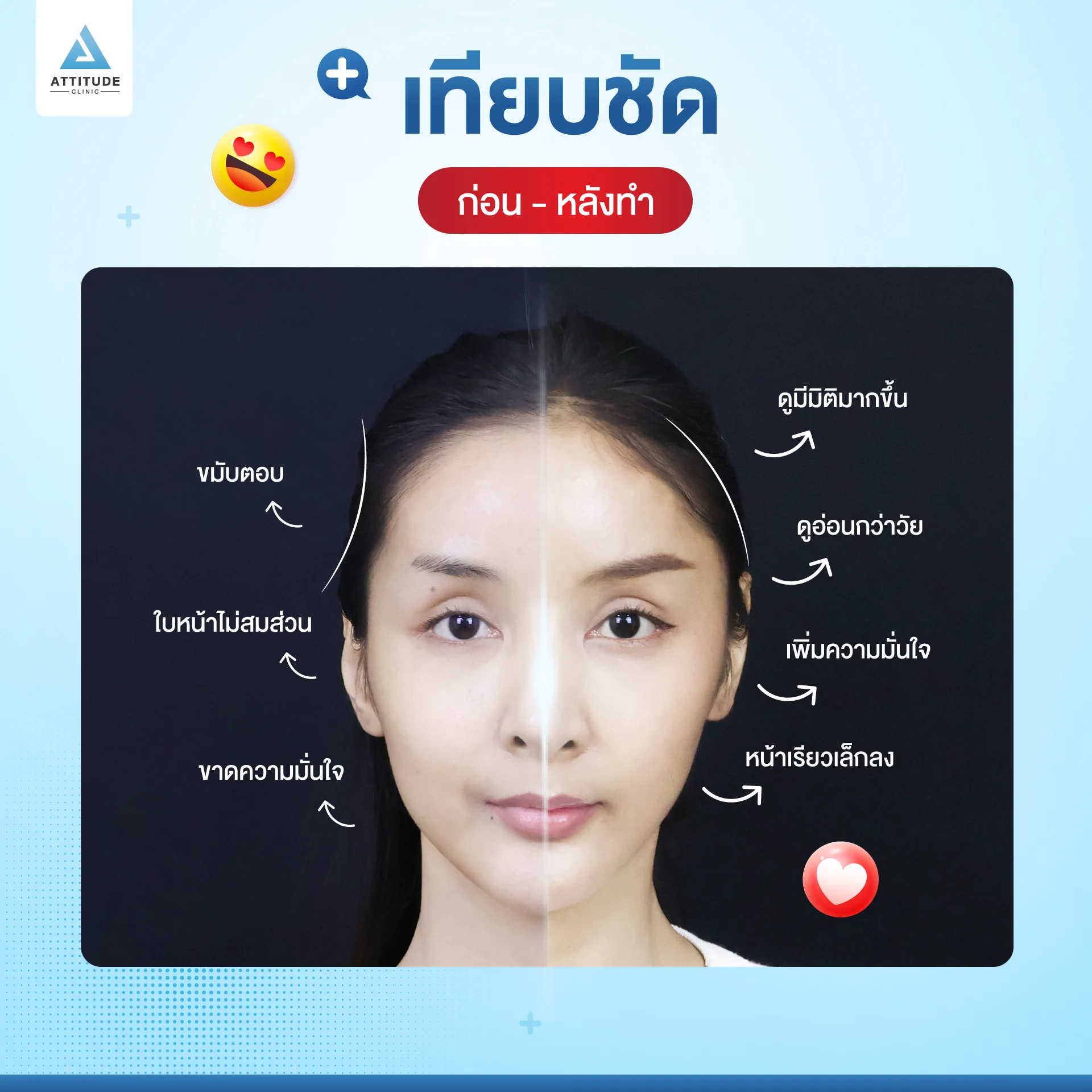 เสริมขมับ