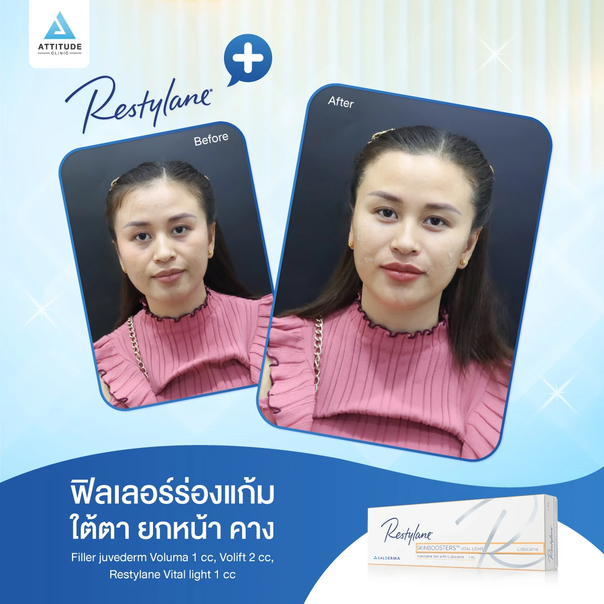 ฟิลเลอร์ Restylane