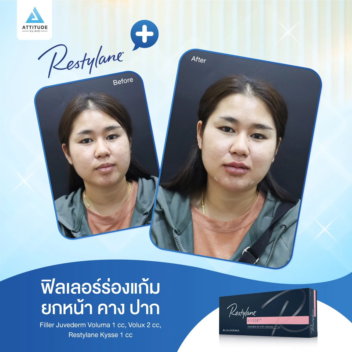 ฟิลเลอร์ Restylane