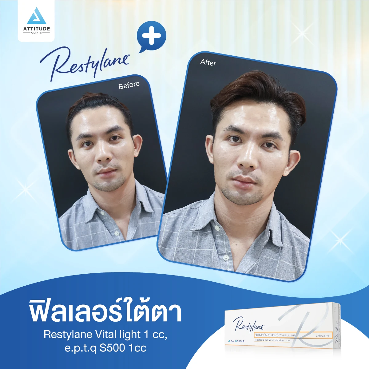 ฟิลเลอร์ Restylane