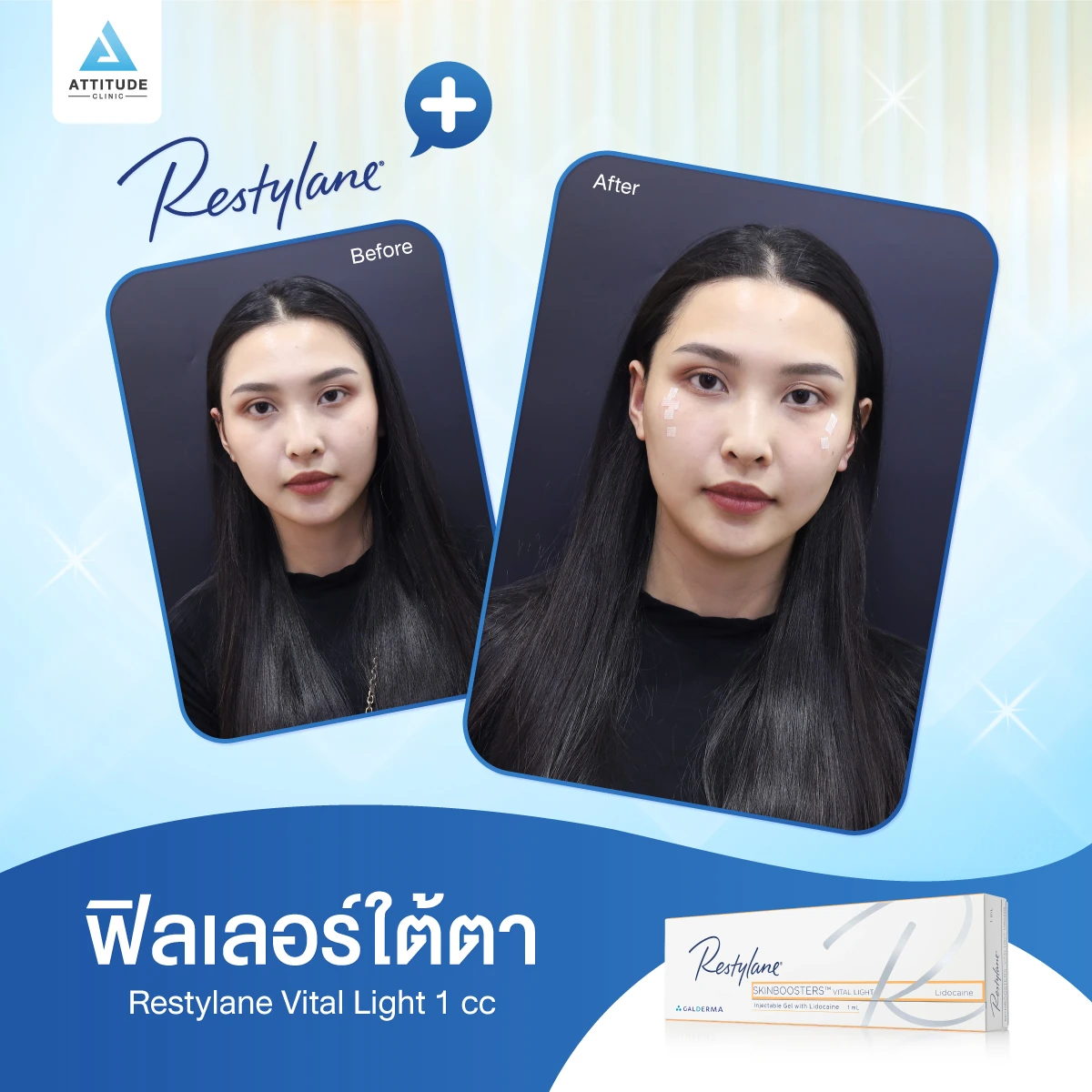 ฟิลเลอร์ Restylane