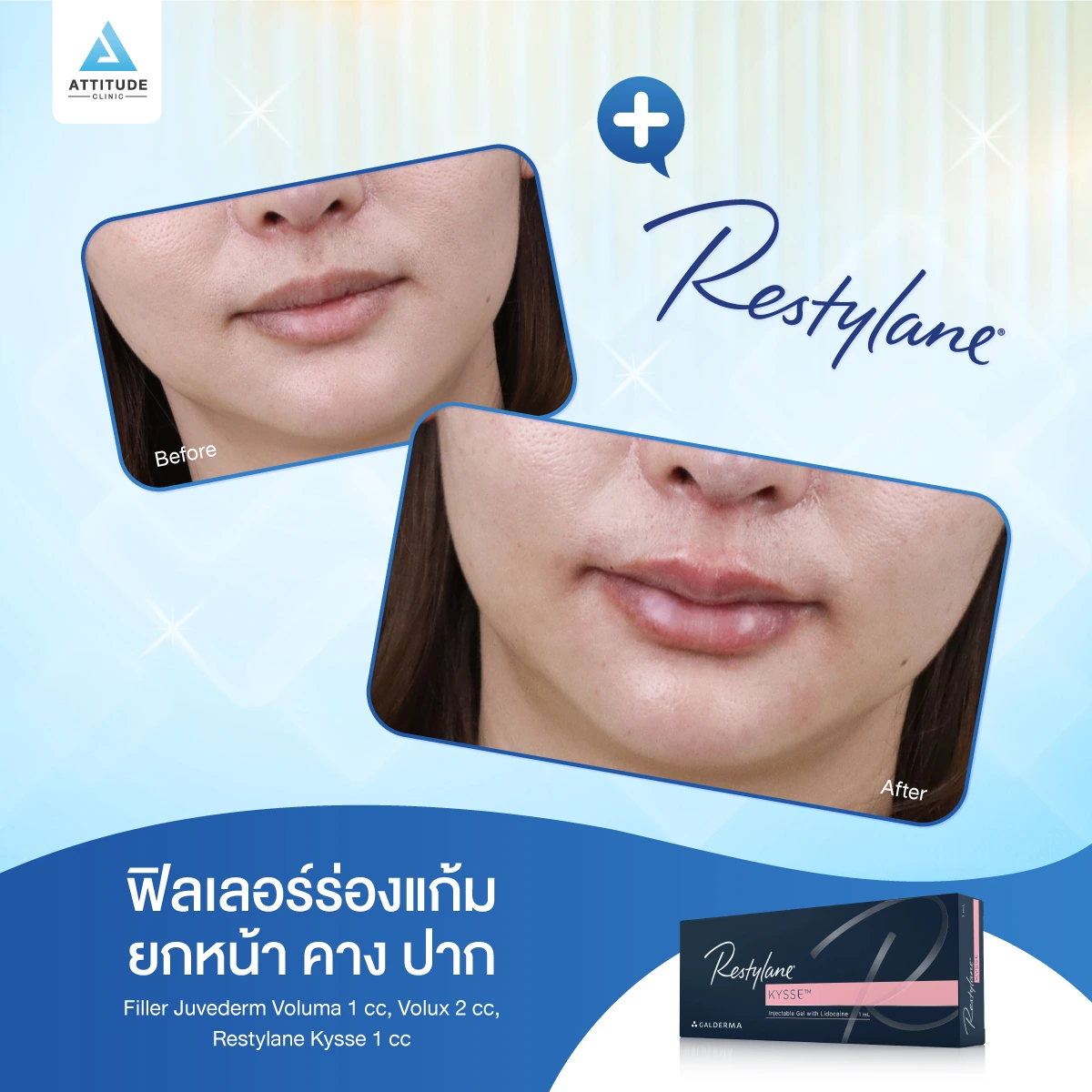 ฟิลเลอร์ Restylane