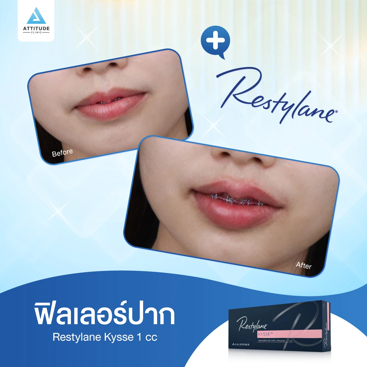 ฟิลเลอร์ Restylane