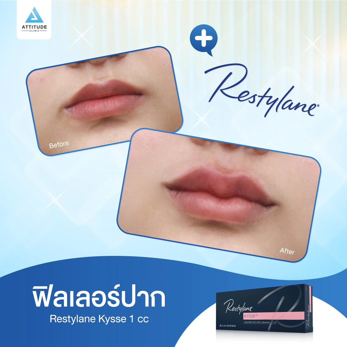 ฟิลเลอร์ Restylane