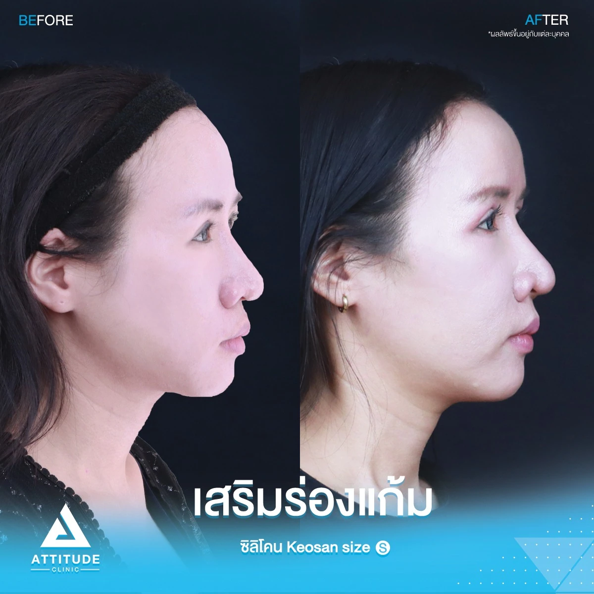 เสริมร่องแก้ม