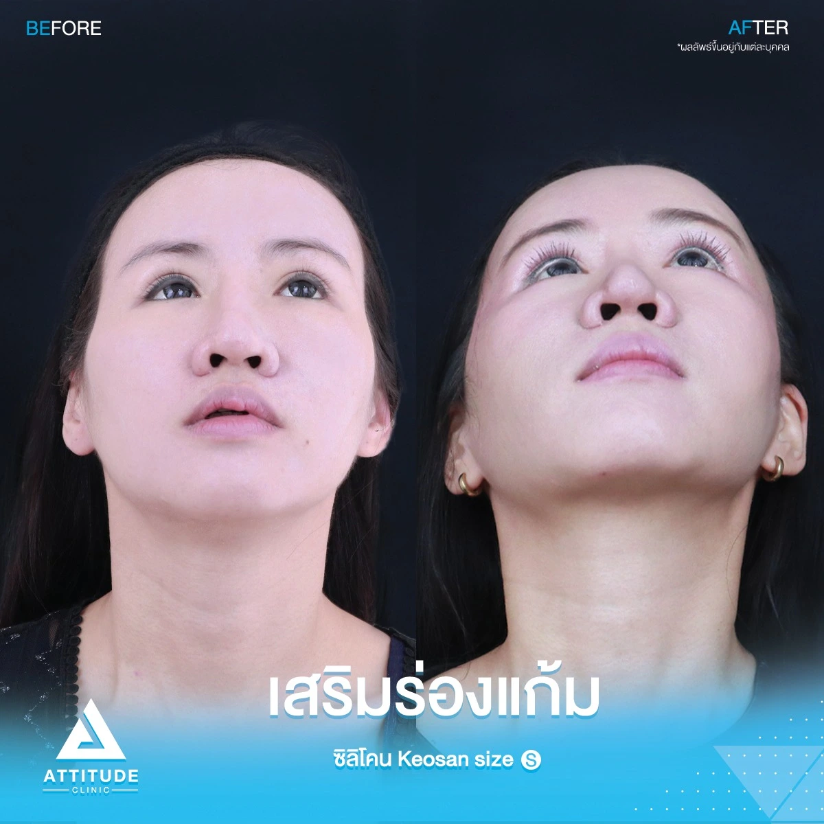 เสริมร่องแก้ม