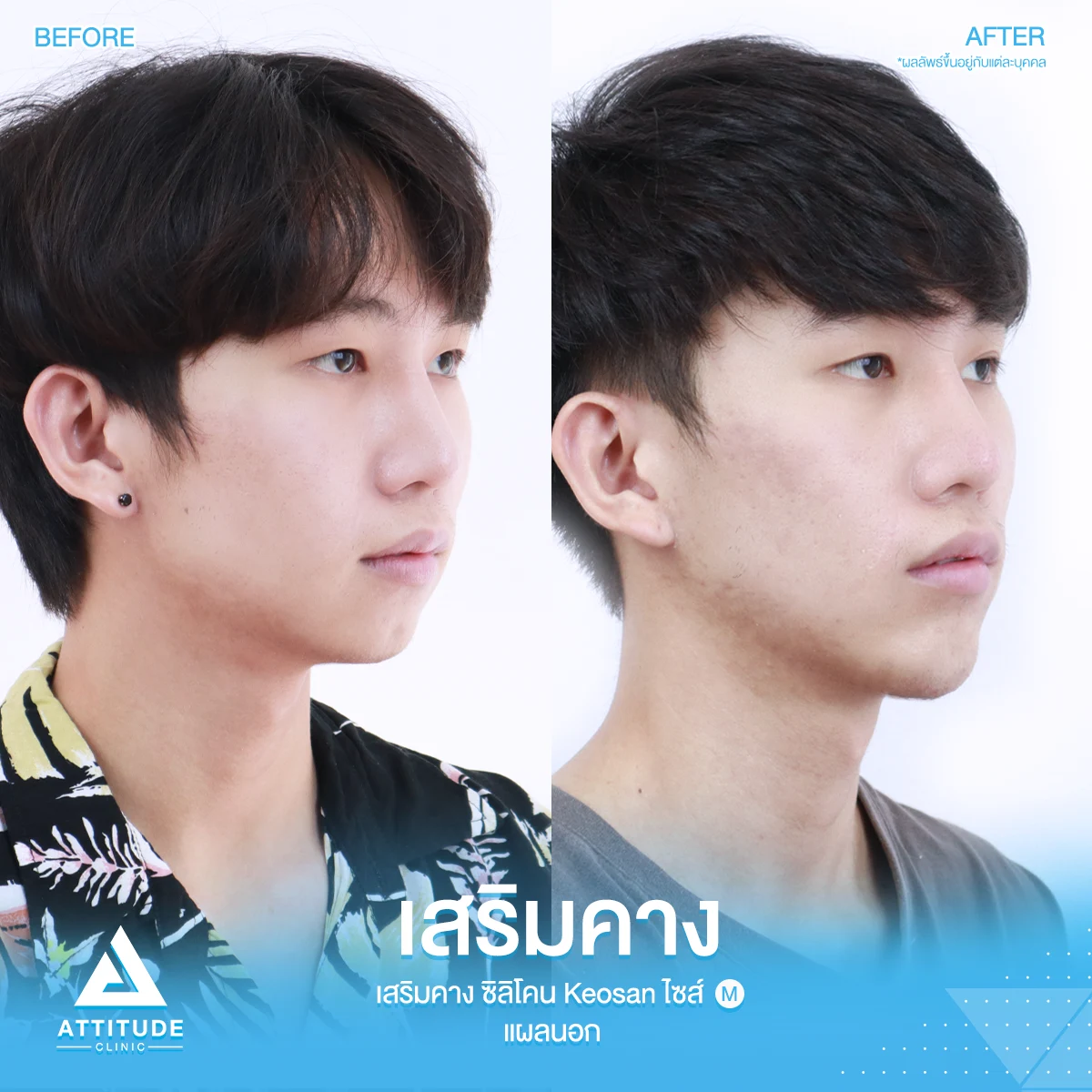 เสริมคาง