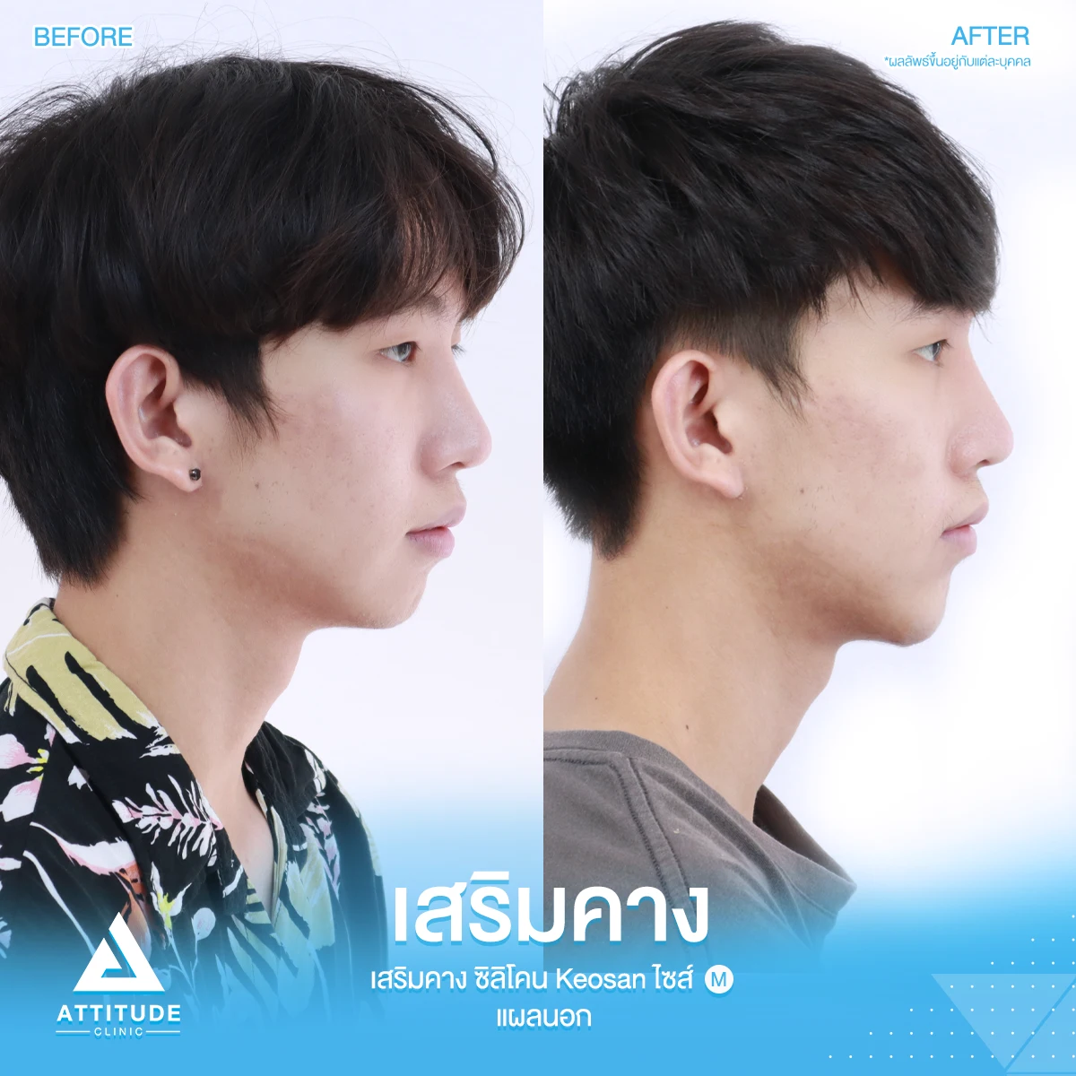 เสริมคาง