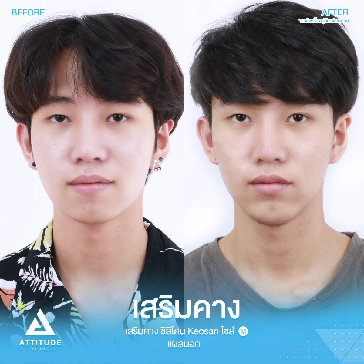 เสริมคาง