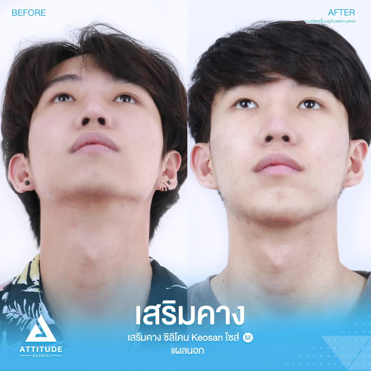 เสริมคาง
