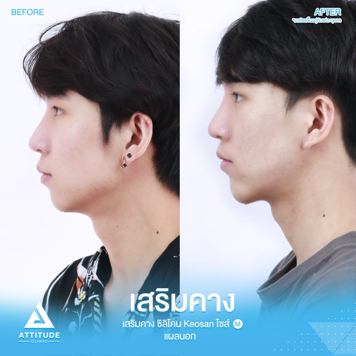 เสริมคาง