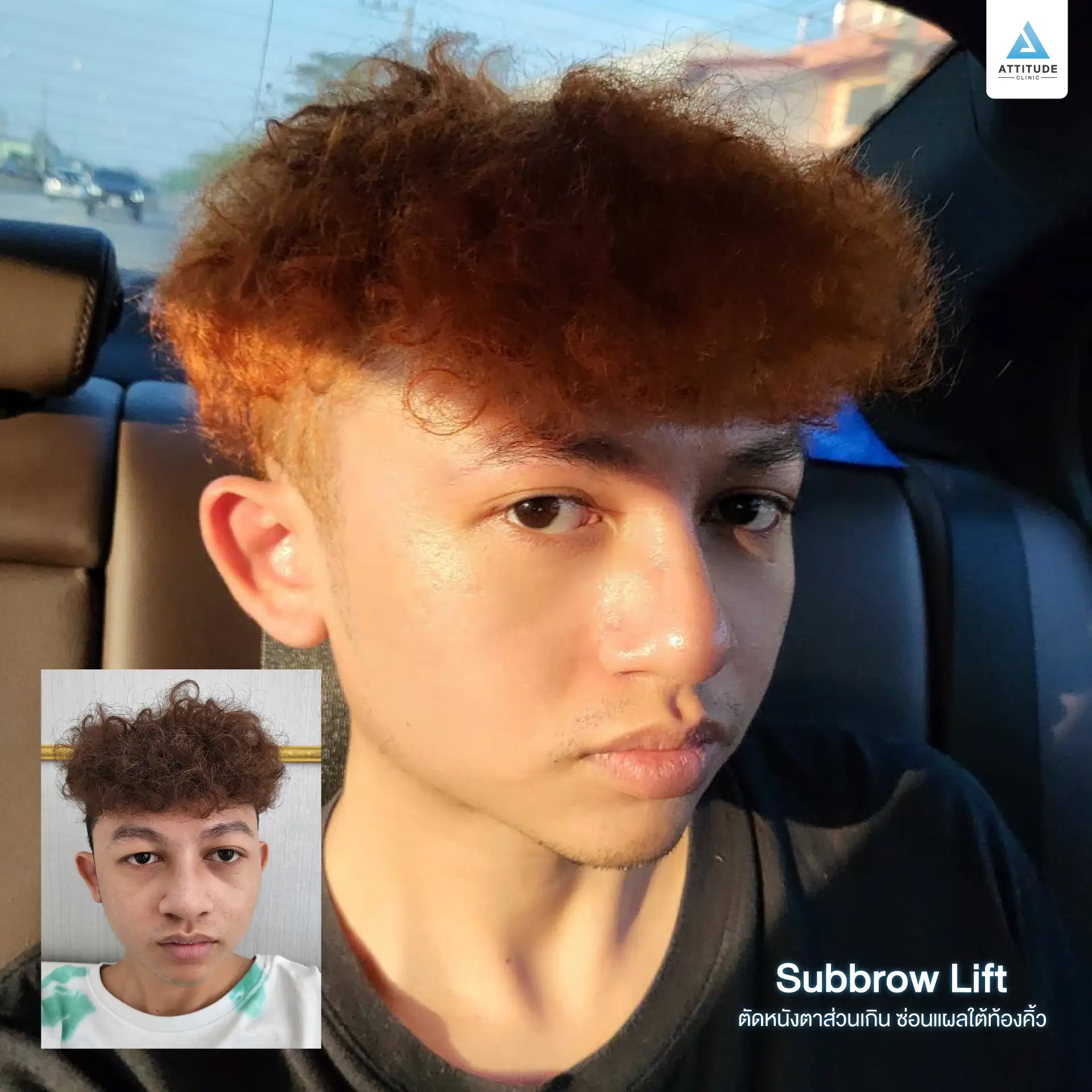 Sub Brow Lift
