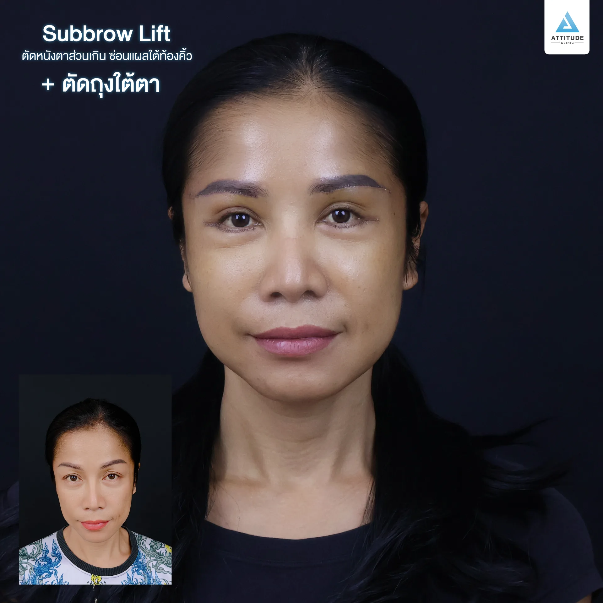 Sub Brow Lift